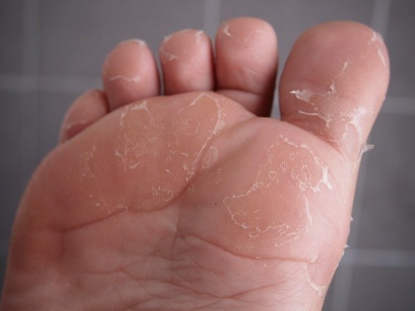 Footlogix 7 vaahtovoide hilselevä, kuoriutuva ja/tai sienimäinen iho